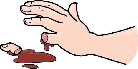 Amputation Finger (C)nsfsakai Amputation Finger (C)nsfsakai