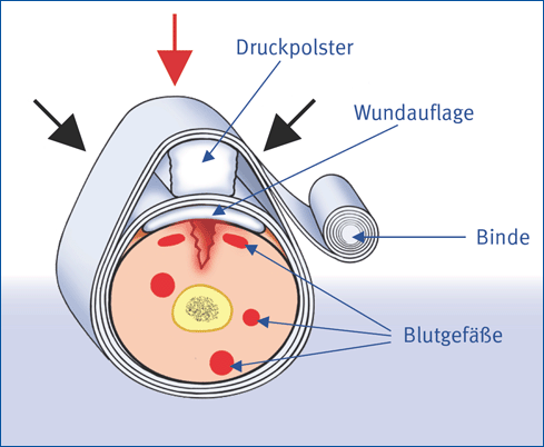 Druckverband (C) Bild BGBAU